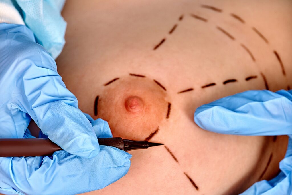 Alternatives naturelles à la chirurgie mammaire